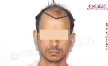 Dr. Suneet Soni - 4533 Grafts, Combine FUT + FUE Technique , NW-IV/V