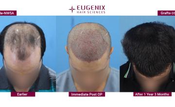 EUGENIX HAIR SCIENCES | NW5A | 1 YEAR RESULT