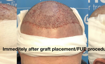James' FUE hair transplant by Dr Arshad (The Hair Dr Clinic, Leeds - UK) - Full Journey