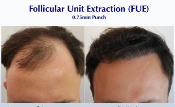 Small Punch. Big Results (2717 FUE grafts): Carlos K. Wesley, M.D. (NYC & LA)