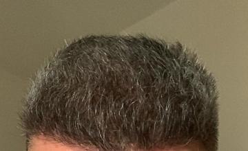 FUE Result for 2 Sessions – 5420 Grafts – HDC Hair Clinic – Dr Maras