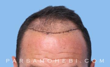 32 Year Old Male with Class IV Hair Loss by Dr. Parsa Mohebi