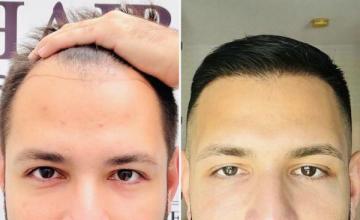 Bogota Hairlines w/ Dr. Camacho - 2138 Grafts