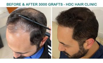 Result of 2  FUE Sessions For Total 5700 grafts -  Front and Crown – HDC Hair Clinic