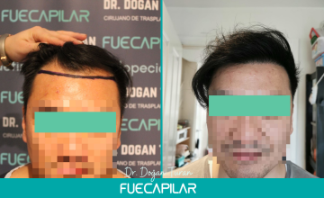 Dr. Turan - FUECAPILAR Clinic, NW III + Diffuse thinning, 3284 grafts