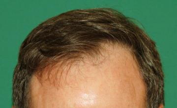 Raymond Konior, MD | Chicago Hair Institute | 2200 Graft Frontal Hairline Restoration