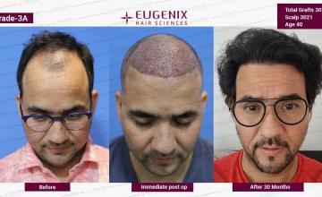 Flawless Hair Restoration Results | Naresh Singh | 2.5 Years Update @Eugenix Hair Sciences