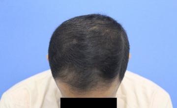 FUE Hair Transplant Result | 1-year post-op | Dr. Kapil Dua