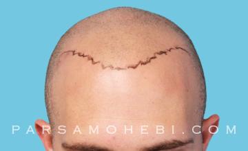 25 Year Old Male with Class VI Hair Loss by Dr. Parsa Mohebi