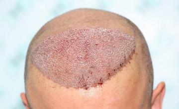 Hair Transplant Result - 10 months after – 5750 grafts in 2 FUE Sessions- Dr Christina – HDC Hair Clinic