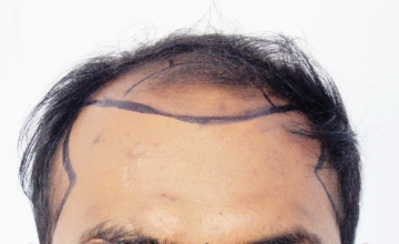 Dr. Suneet  Soni - 3850 FUT Grafts, NW V