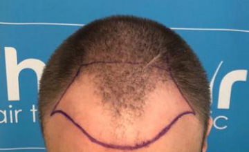 Matt's FUE hair transplant result - Dr Arshad (The Hair Dr Clinic - Leeds, UK)