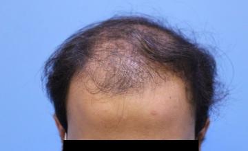 Dr. Kapil Dua | 2530 Graft FUE Hair Transplant | 1-year post-op