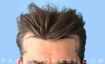 40 Year Old Male with Class III Hair Loss by Dr. Parsa Mohebi