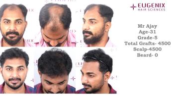 4500 GRAFTS | DR. ARIKA BANSAL | EUGENIX HAIR SCIENCES