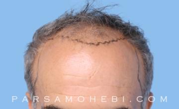 54 Year Old Male with Class IV Hair Loss by Dr. Parsa Mohebi