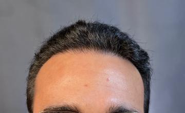 Dr. Arocha | 1500 Graft FUE Repair Case