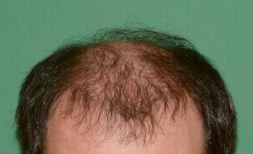 Raymond Konior, MD | Chicago Hair Institute | 3370 Graft Repair with Combination Strip/FUE Harvest