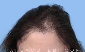 56 Year Old Female with Atypical Hair Loss by Dr. Parsa Mohebi