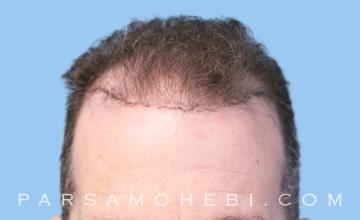 41 Year Old Male with Class IV Hair Loss by Dr. Parsa Mohebi