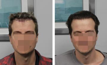 Dr. Blake Bloxham: FUE Hairline Case Results | 1,500 Grafts | Feller & Bloxham Medical, NY, NYC, LI