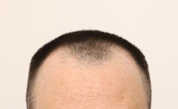 Dr. Robert Dorin ~ 1733 Graft FUE ~ 7 months post-op