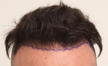 Dr. Robert Dorin -  Revision - 888 Hairline FUE