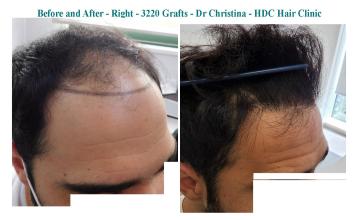 17 Months after 3320 FUE Grafts – Dr Christina – HDC Hair Clinic