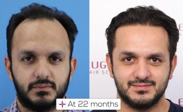 Amazing 22 Months Result of Hair Transplant, 3024 Grafts @Eugenix Hair Sciences