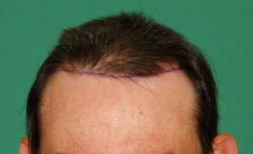 Raymond Konior, MD | Chicago Hair Institute | 3088 Graft Frontal/Midscalp Hair Restoration