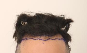 Dr. Robert Dorin ~ 1702 Graft FUE ~ 8 months