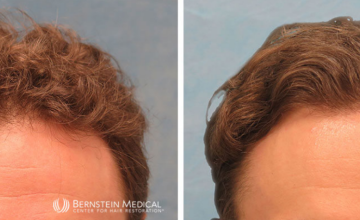 Norwood Class 3V - 1,760 and 1,428 Grafts - Dr. Robert Bernstein