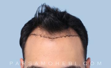 34 Year Old Male with Class III-V Hair Loss by Dr. Parsa Mohebi