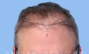 48 Year Old Male with Class III-V Hair Loss by Dr. Parsa Mohebi
