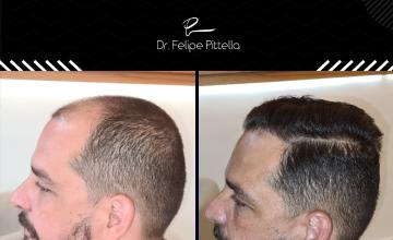 Dr. Pittella • 5549 grafts - NW 4/5 Wavy Hair: SOLVED