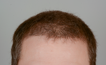 Robert Haber, MD - 2432 grafts FUT, Front & Crown - 1 Year