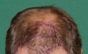 Raymond Konior, MD | Chicago Hair Institute | 4114 Graft Hair Restoration