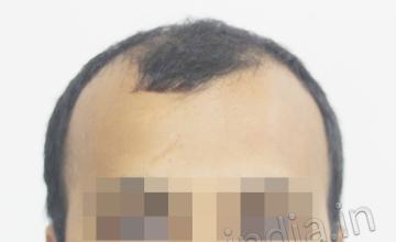 Dr. Suneet Soni - 4070, Combine FUT + FUE Grafts, NW IV