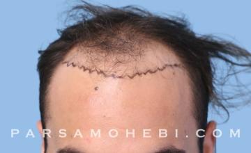 27 Year Old Male with Class IV Hair Loss by Dr. Parsa Mohebi