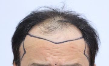 Actor Mr. Mihir Mishra Hair Transplant at Medispa - 5000 Grafts, Combine FUT + FUE + BHT, NW V