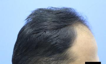 2000 Grafts by Bio-FUE technique - Dr. Kapil Dua @ AK Clinics
