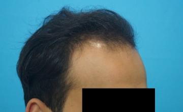 Dr Kapil Dua, India - 12 Months Hair Transplant Result | 1565 Grafts Norwood Grade II