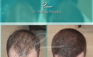 Dr. Pittella • Norwood 4, Fine Hair, Young Patient: SOLVED