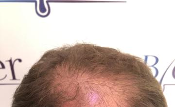 Ozlem Bicer MD-Hair Transplant-3560 Grafts FUE by micro-motor, 9. months result
