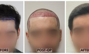 Dr. Rahal - FUE Hair Transplant - 2615 Grafts