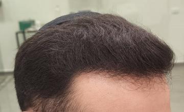 Result of 4900 Grafts on NW5 Patient – 8 Months After – Dr Maras – HDC Hair Clinic