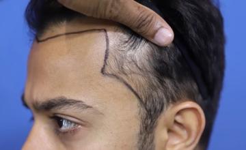 IS THIS THE BEST HAIRLINE EVER CREATED | EUGENIX HAIR SCIENCE | DR. SETHI & DR. BANSAL