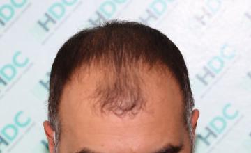 3650 Grafts FUE Result – NW3-4 – HDC Hair Clinic Dr Christina - 1 year After