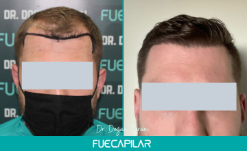 Dr. Turan - FUECAPILAR Clinic, NW III + diffuse thinning , 2575 grafts, Blonde Patient