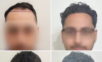 Dr Ruk - 3184 Grafts